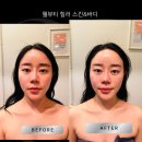 웰뷰파크 | 인계동 얼굴윤곽관리 웰뷰티힐러 리프팅 제대로한 솔직후기