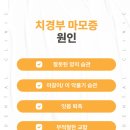 아이오치과의원 | 광주송정동치과 이가 시려요 치경부 마모증