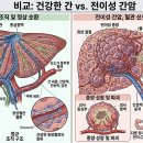 암세포 왜 간으로 전이될까? 간전이 과정과 몸의 변화 이미지