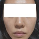 [강남역성형외과] 올리팅 튠페이스 얼굴볼륨 시술후기