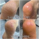 발각질역곡 추천 페디프로 부천역곡점 문제성 발각질 스케일링 효과 리얼 후기