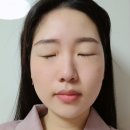 하상한방병원 | [대구필러 대구보톡스] 하이코, 코필러, 턱보톡스, 달걀주사 시술다짐부터 1주차 솔직후기