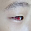 신비의료기 | 고대안암병원 간헐적 외사시 수술후기