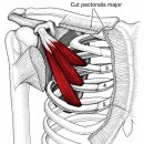 흉근(Pec Minor)과 만성통증 왜 목·어깨 통증까지 연결될까? 이미지