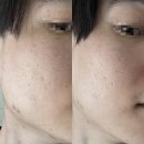 차오름파트너스 | 쥬베룩 스킨 2회차 후기｜여드름 흉터 전후 비교 (내돈내산 4편)