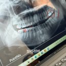 보라멍 | 아래 매복사랑니 발치 후기｜걱정 많았지만 잘 회복 중 (붓기·멍·식사 기록)