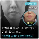 숨은그림성형외과의원 | 팔자주름 아닌 심부볼? 다움성형외과 김대현 원장의 걸리버리프트 후기