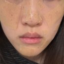 수원-1327 | 수원 용인 기미잡티 제거 미작뷰티 수원점 제로스팟 후기