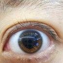 전주안과의원 | [전주 푸른안과] 스마일 라식 후기_내돈내산