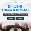 더나은치과기공소 | 도남동치과 다수 치아를 상실했을 때 전체 임플란트
