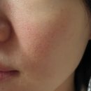 광주여드름흉터치료 광주모공치료 도자기피부결 내돈내산 첨단쥬네르의원 추천