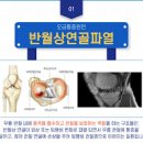 무릎뒤쪽 오금 아플때 통증 원인 이미지