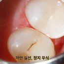 수원정성치과의원 | 수원 충치 치료 치과 , 무통 마취기 그리고 정지 우식