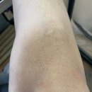 다리 인그로운헤어 제거 관리 | 왁싱 후기