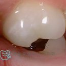 서울효앤주니어치과의원 | [공지] 어린이영구치 심한 충치, 발치하지 않고 최대한 살려내는 서울효앤주니어치과