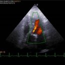 Dilated Ascending Aorta 이미지