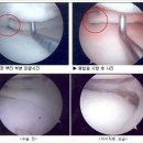 **십자인대파열,무릎연골파열,관절내시경~~~ 이미지