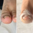 만성로 | [레푸스 전주혁신점] 전주내성발톱 엄지 2개 교정 일주일 뒤 바로 펴진 후기 (비교 사진 있음)