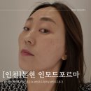 (주)건강드림 | 인천논현피부과 인모드 포르마 forma리프팅 후기 가격 효과 통증 모두 알려드림!