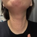 이지이샵 | 피부과 재생크림 추천 포스트랩 홈쥬란 레이저 후 관리로 사용해본 재생크림 후기