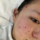 큐어짐 | [서울/잠실] 여드름 압출 잘하는 잠실 에스테틱 루아에스테틱 잠실본점 큐어아크네 솔직 후기