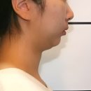 삶 | 무턱교정 전후 1년, 달라진 삶에 관한 후기