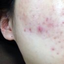 안정약국 | 스카바이겔 약국 연고 여드름 흉터제거 후기
