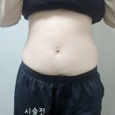 복부실리프팅가격, 통증, 한달 솔직 후기! 출산 후 처진 뱃살 리프팅 후기