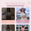 라인앤뷰의원 | 라인앤뷰의원 복부+옆구리+러브핸들+힙윗라인+음부치골+하등+허엉무샤 지방흡입 5개월 전후 (Feat. 병원...