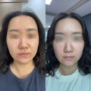 울산삼산피부과에서 맞은 인생 첫 리쥬란힐러 1주일 후기(엠보사진, 경과사진)