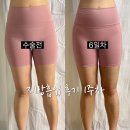 교대역약국 | 강남 교대역 허벅지지방흡입 지흡 솔직후기 1주차 붓기 준비물 약국꿀팁