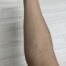 A형독감 기간 후기 증상 치료법 타미플루 페라미플루 수액 부작용 독감검사 비용 실비 서류