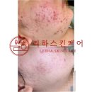 리하스킨케어 | 청소년 여드름 리얼후기 ㅣ 내방역 여드름 전문 리하스킨케어에서