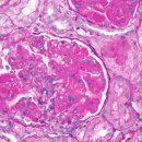 메디렉스 | 루푸스 치료 분야 새로운 경쟁 도래