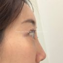 리블룸의원 | 원주피부과/10년 된 콧대필러 녹이기/ 오래된 필러 녹이기+턱윤곽 주사/아픔 강도/원주리블룸의원