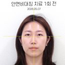 삼성한의원 | 삼성중앙역비대칭한의원 안면비대칭한의원 2회차 후기 (비포애프터 첨부)