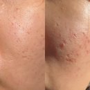 고려한의원 | 내돈내산 수원한의원 여드름흉터치료 새살침+차침(결치료) 2차 시술 후기