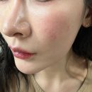 아진솔루션 | 신논현역피부과 아기레이저 받고 아기피부 만들고 온 후기!! (아기레이저 가격, 효과 포함 꼼꼼 리뷰)