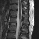 터진디스크(extrusion disk)는 무조건 수술 해야 하나요?? 이미지