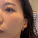 대교의원 | 압구정역피부과 쿨소닉 잘하는곳 후기 전후비교 통증(아르나의원)