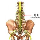 척추수술 후 발생한 마미증후군 - 신경인성 방광 이미지