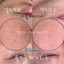 콜드 플라 송파 이미지
