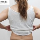 역삼2 | 내돈내산 역삼다이어트주사 2회차 후기 눈바디 변화와 지방분해 과정 공유