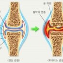 골관절염치료기
