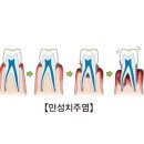 치주염 증상과 진행과정에 대한 설명 이미지
