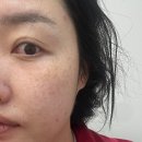 리나스킨케어 | 율량동 피부관리 리나뷰티 성인여드름 케어 받고 온 후기