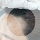 임헤어라인