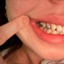 초월가까운약국 | 20대 후반 성인의 악궁 확장 및 교정 후기 #2 - 악궁확장 식립과 2주 후기