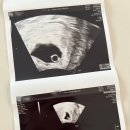 박동농장 | 22_대전 난임병원 생명의 정원 6주차 난황, 심장박동 확인 💗