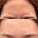 두가 | 부산 이마보톡스 잘못맞은 내돈내산 후기